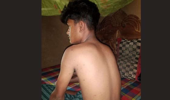 জুলাই বিপ্লব: গুলি পিঠে ও পায়ে এখনো তোফাজ্জল হোসেনের, ভবিষ্যৎ নিয়ে দুশ্চিন্তা