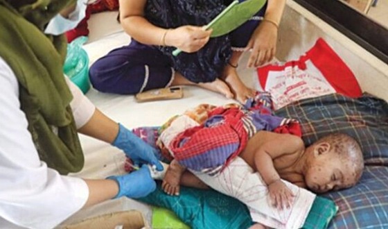 বরিশালে হাম আক্রান্ত হয়ে আরো দুই শিশুর মৃত্যু
