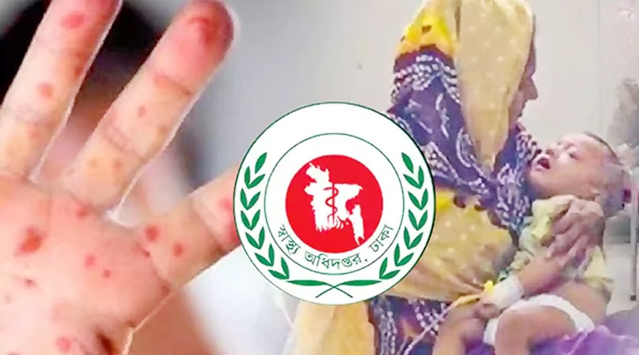 হামের উপসর্গে আরও ৮ শিশুর মৃত্যু