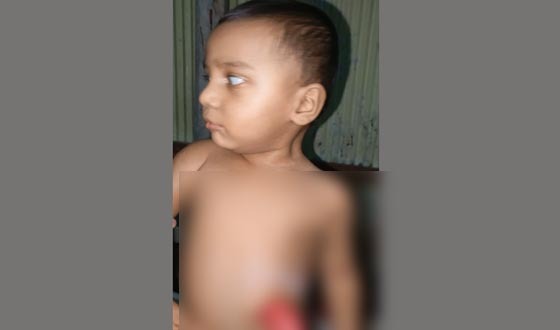 শিশু আহনাফের জীবন বাঁচাতে তৃতীয় অপারেশন, অর্থসংকটে ইমাম বাবা