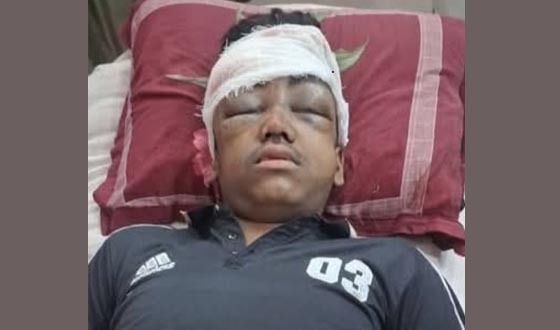 দৌলতপুরে যুবদল নেতার পুত্র বিল্টু সড়ক দুর্ঘটনায় আহত