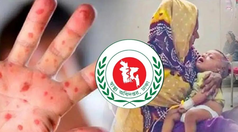 হামের উপসর্গে আরও ৫ শিশুর মৃত্যু, প্রাণহানি বেড়ে ৮১০