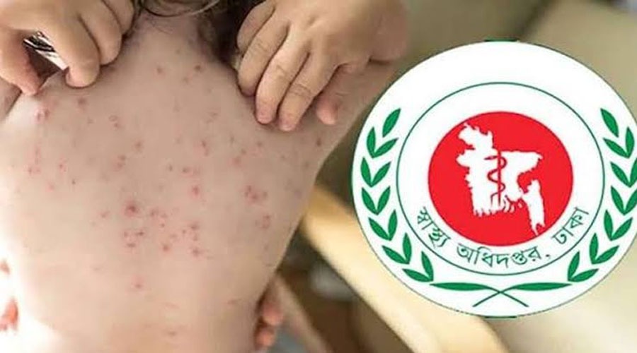 হামের উপসর্গে আরও ৪ শিশুর মৃত্যু, মোট প্রাণহানি ৮২০
