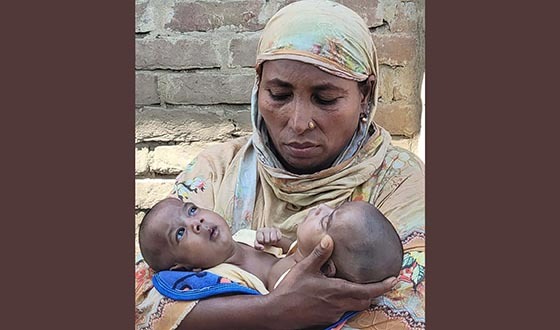 দৌলতপুরে জন্ম নিলো এক দেহে দুই প্রাণের ফুটফুটে জমজ কন্যা সন্তান
