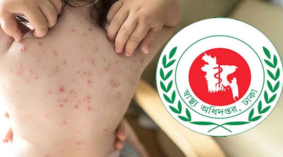 হামের উপসর্গে আরও ৩ শিশুর মৃত্যু