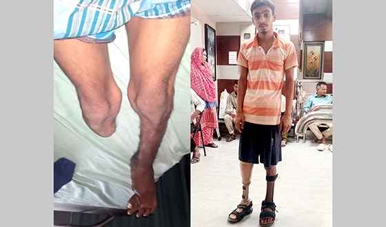 নাজমুলকে উন্নত প্রযুক্তির কৃত্রিম পা উপহার দিলেন ডা. লিটন এমপি