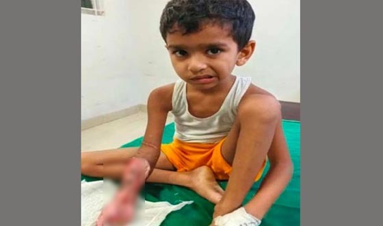 ঘোড়াঘাটে পল্লী চিকিৎসকের ভুল চিকিৎসায় চার আঙ্গুল হারালো শিশু