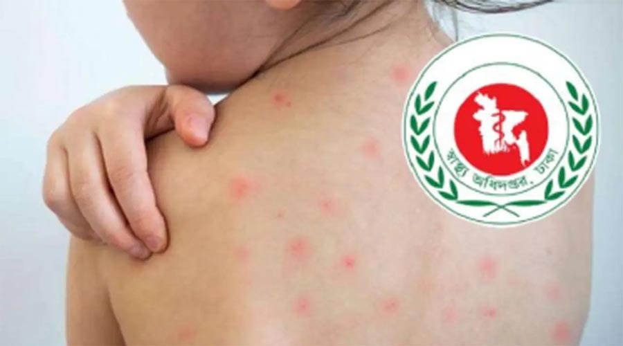 হামের উপসর্গে আরও ৩ শিশুর মৃত্যু, মোট প্রাণহানি ১২০৪