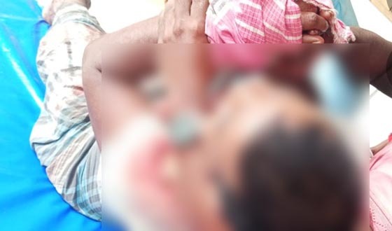 জামালপুরে প্রতিপক্ষের ধারালো অস্ত্রের আঘাতে যুবকের হাতেরকব্জি কর্তন