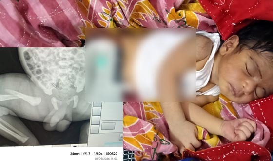 থেরাপি দেওয়ার কথা বলে নবজাতকের পা ভাঙলেন নার্স
